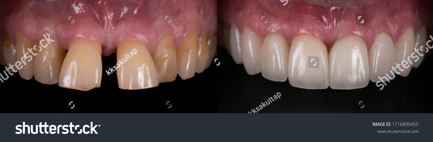Teeth Whitening